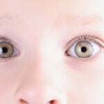 Estrabismo en bebés: Todo lo que debes saber sobre ello